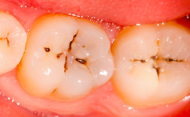 Этиология и патогенез кариеса зубов