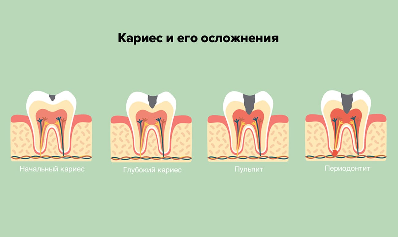 Почему болит зуб после лечения мышьяком