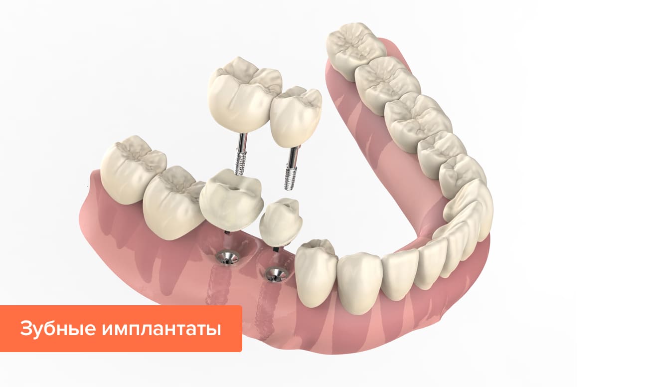 Зубные имплантаты