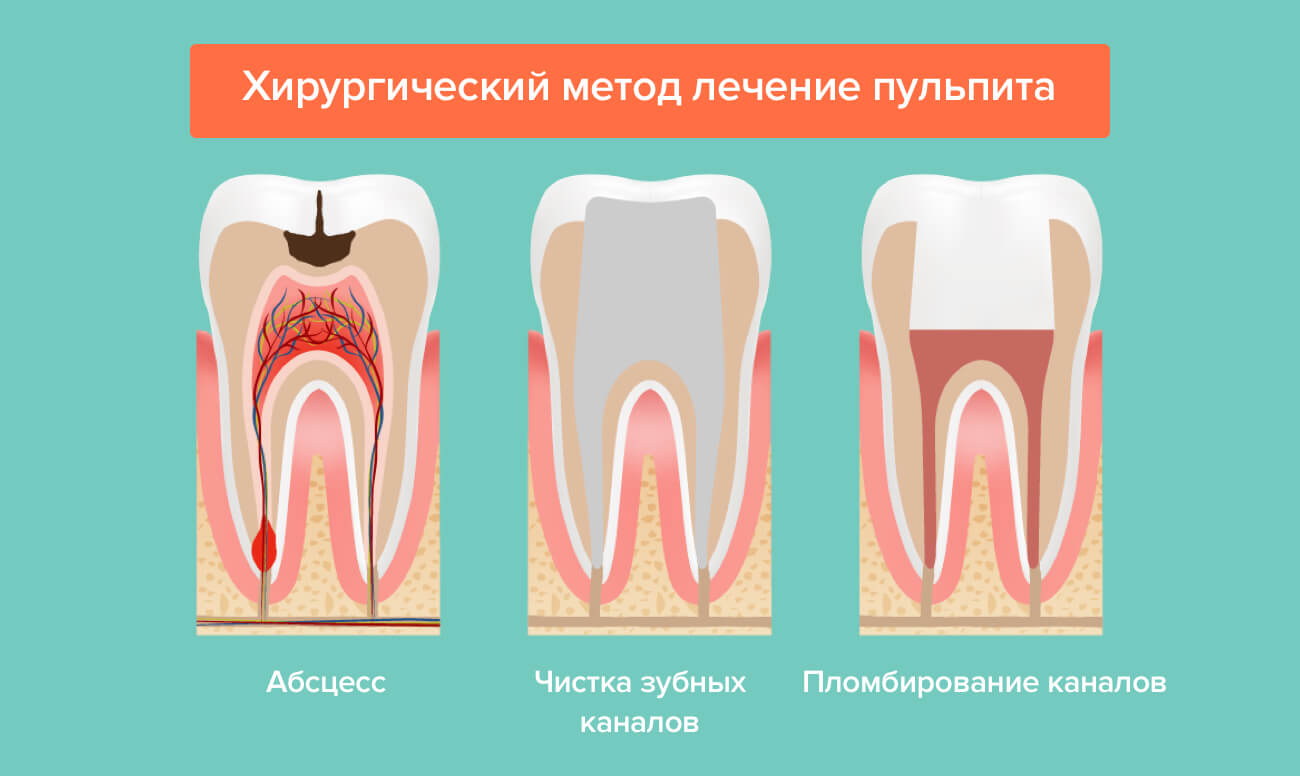 Лечение пульпита и восстановление зуба световой пломбой