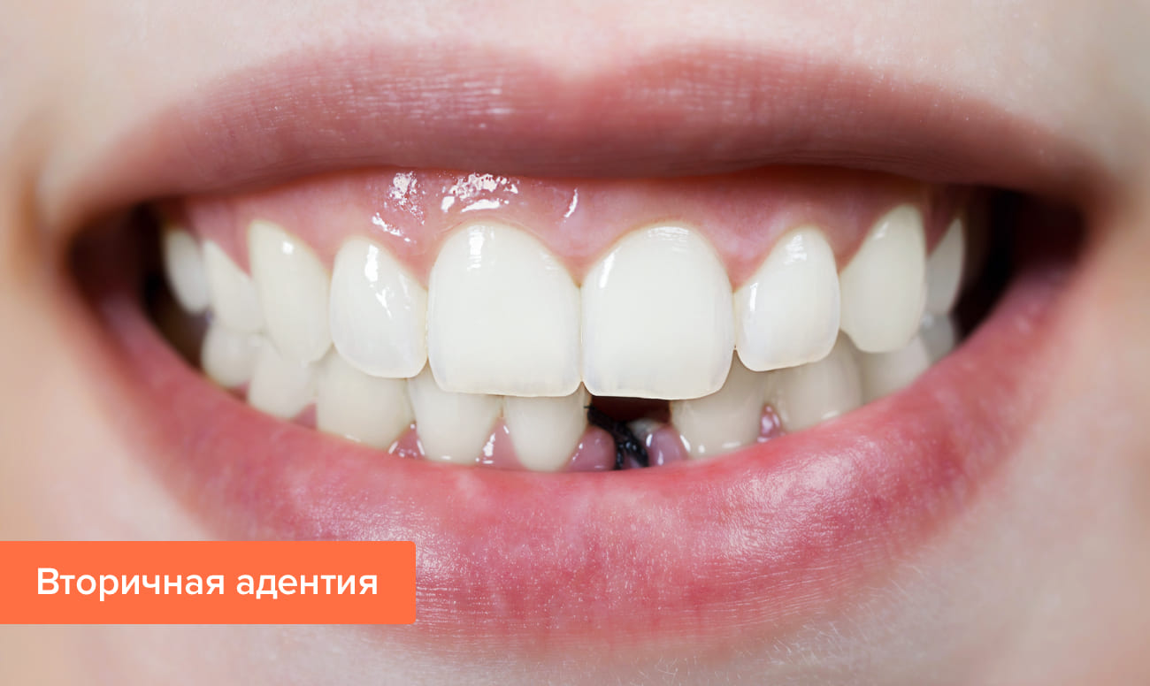 Отсутствие фронтальных зубов