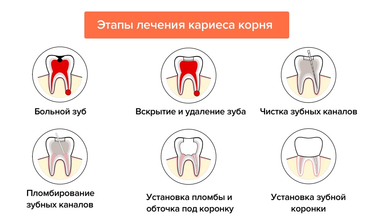 Лечение кариеса корня зуба в Санкт-Петербурге