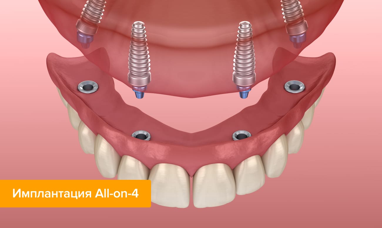 Протезирование зубов на имплантах что такое при полном отсутствии