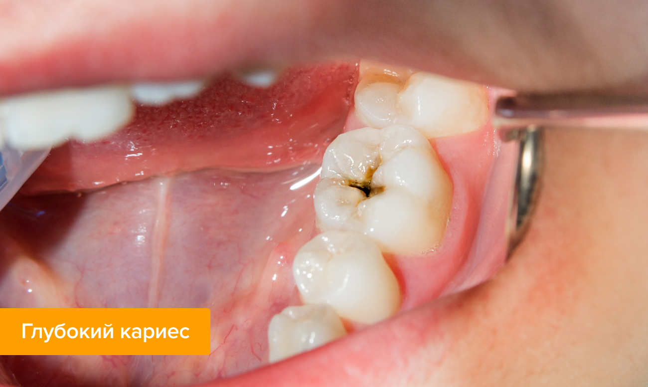 Что делать, если болит зуб? | Виды и причины зубной боли