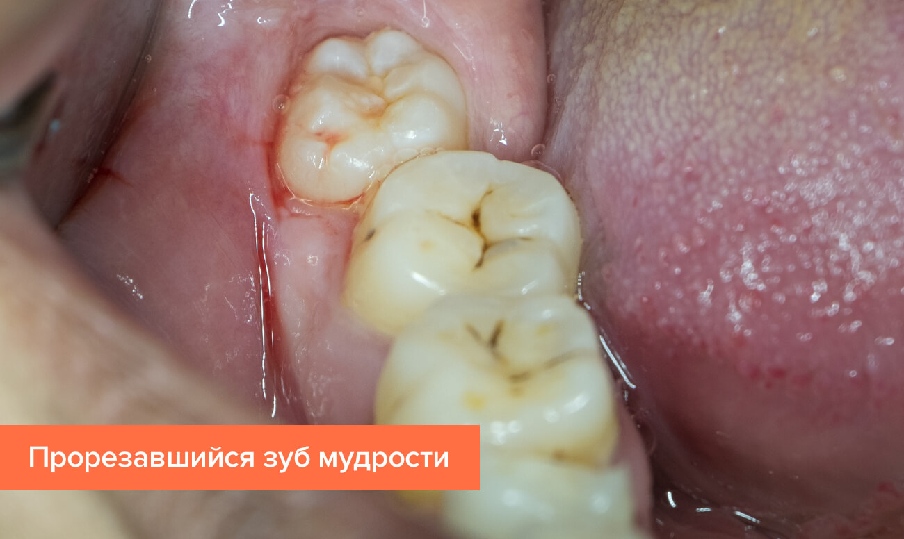 Бывает ли при прорезовании зубов красное горло?