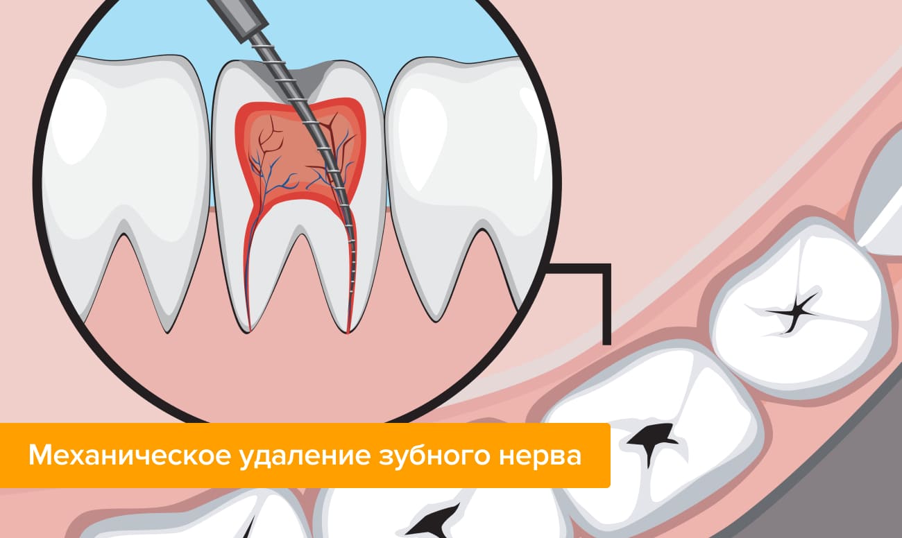 Как убить нерв в зубе?