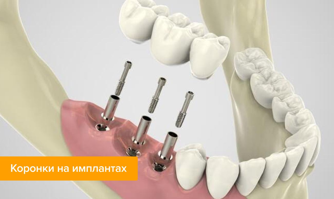 Протезирование на имплантах что это такое