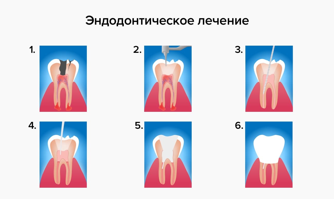 при флюсе можно удалять зуб