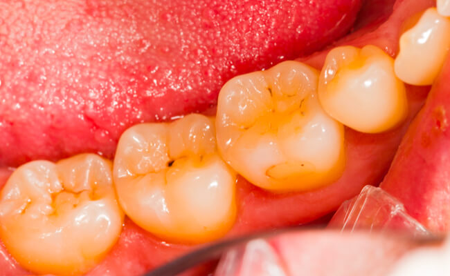 Гнилые зубы: причины и способы лечения
