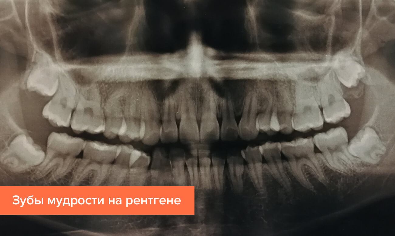 Зуб 8 корень. Зубы мудрости на нижней челюсти рентген. Ретинированный зуб мудрости рентген. Ретинированный зуб на верхней челюсти. Полуретинированный зуб мудрости рентген.