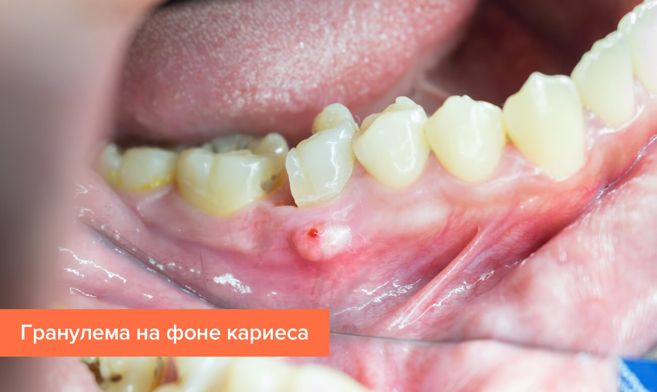 Гранулема зуба – причины и лечение