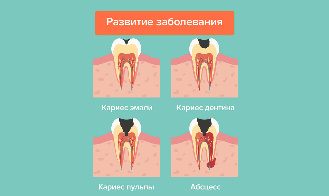 Трещина на зубе (переднем, жевательном), что делать если треснул зуб