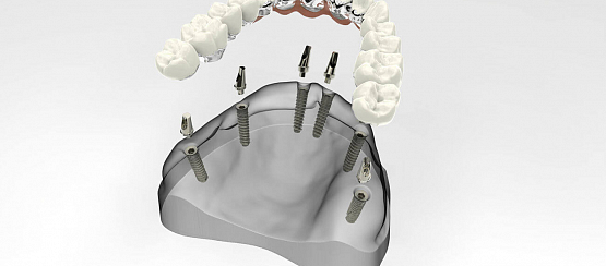 Съемный протез на имплантах