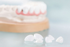 Люминиры на зубы: все за и против