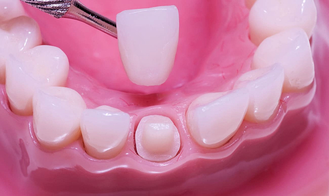 Виды стоматологического цемента, их особенности и отличия