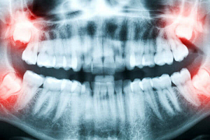 Нужно ли убирать турунду после удаления зуба?