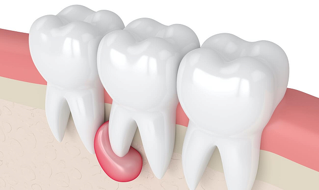 Лечение кисты зуба – без удаления, цена в СПб. Лечение периодонтита