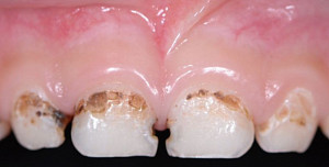 Остеонекроз нижней челюсти на фоне приема бисфосфонатов