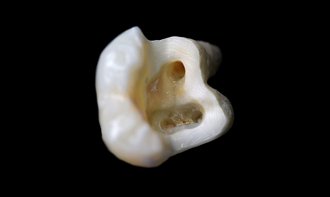 Лечения деструктивных форм периодонтитов (кист или гранулем) с сохранением зуба