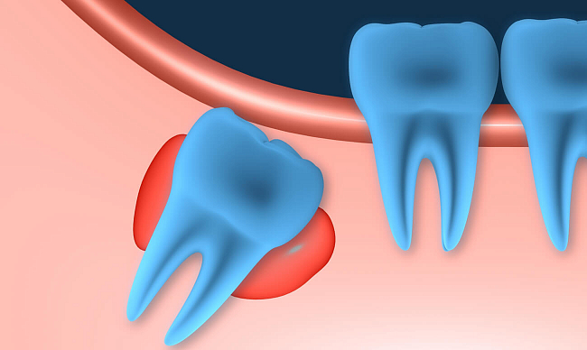 Лечение кисты зуба народными средствами в домашних условиях