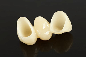 Emax - коронки за один день