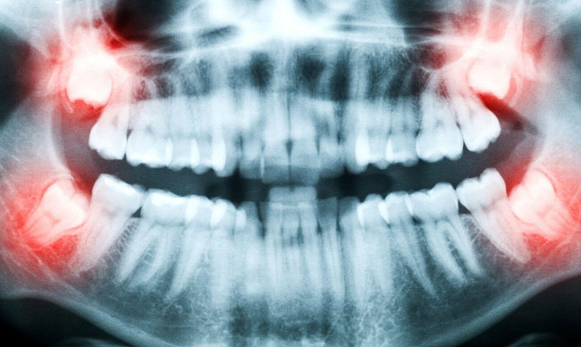 Нужны ли антибиотики после удаления зуба? - на портале жк-вершина-сайт.рф