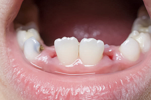 Как заживает десна после удаления зуба