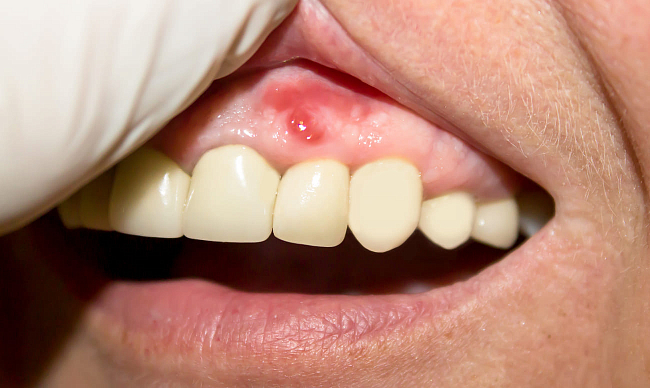 при пародонтозе можно ставить зубные импланты