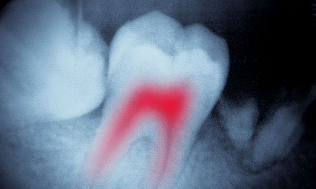 Разновидности кистозных образований на зубе